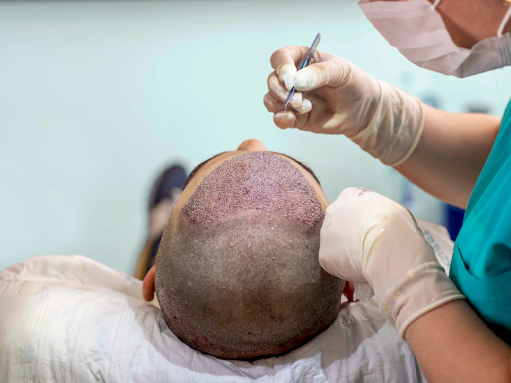 California's Most Trusted Hair Transplant Clinic