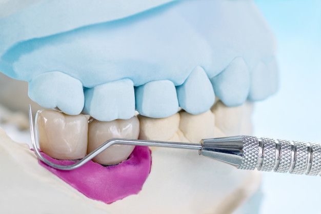 The Complete Guide to Dental Implants in Aberdeen
