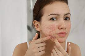 Spot-Free Success: Your Acne-Free Journey | Acne treatment