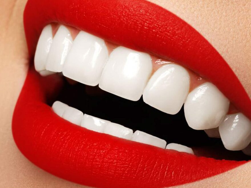 Top Rated Dental Veneers Clinic in Dubai,