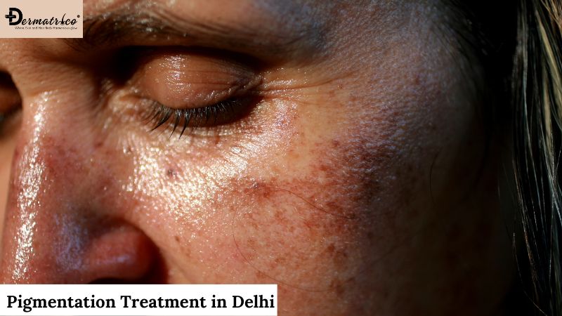 pigmentation treatment in delhi