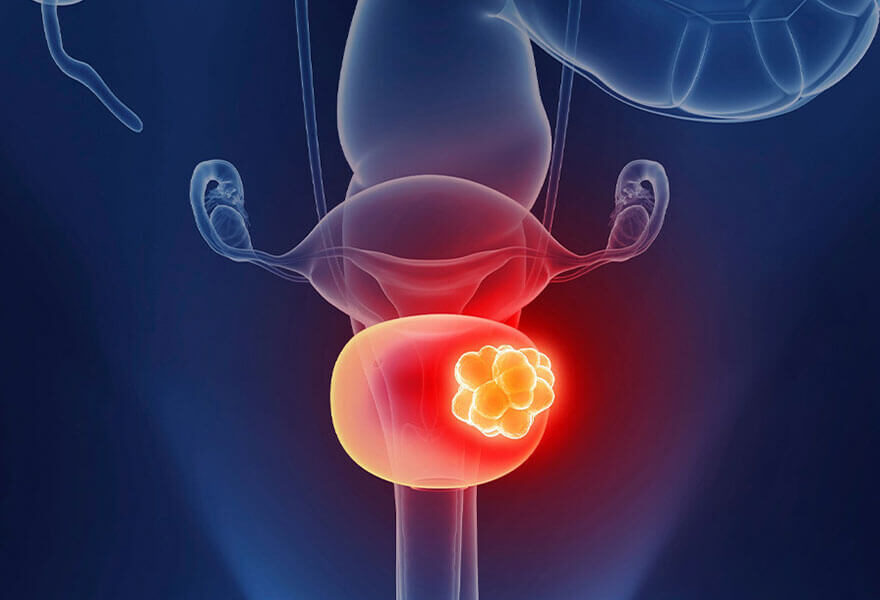 bladder cancer treatment