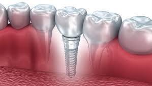 Unlocking the Secrets of Dental Implants